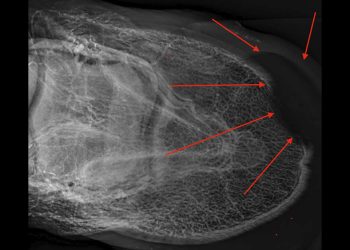 Sobbattiture e ascessi sempre meno nascosti con la venografia